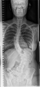 X-ray-Scoliosis.jpg